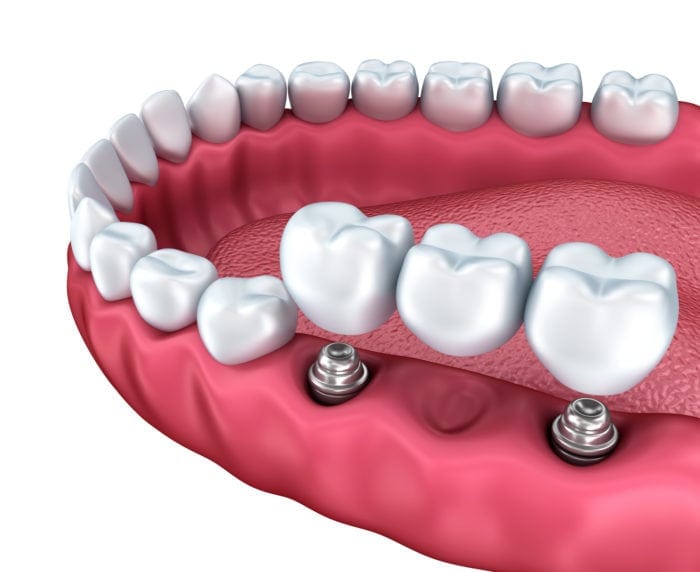 implant supported dental bridge for missing teeth new philadelphia oh