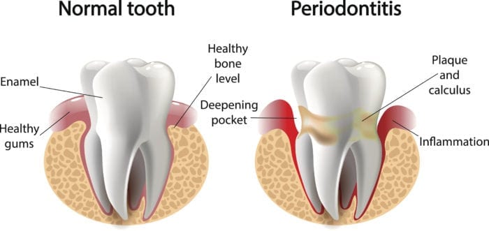 gum disease treatment periodontal treatment new philadelphia oh