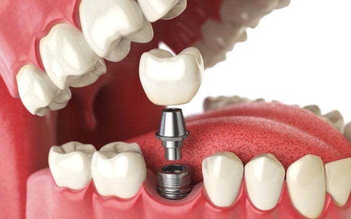 dental implants for missing teeth new Philadelphia oh