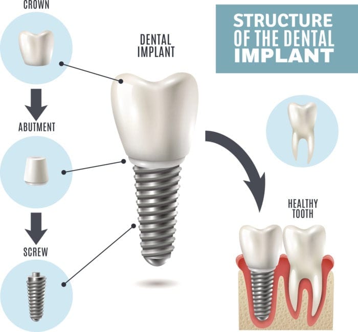 dental implant replace missing tooth new philadlephia oh