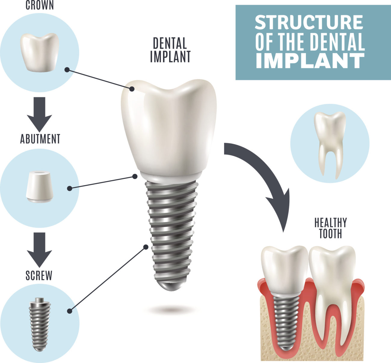 What are the benefits of dental implants? Replace Missing Teeth
