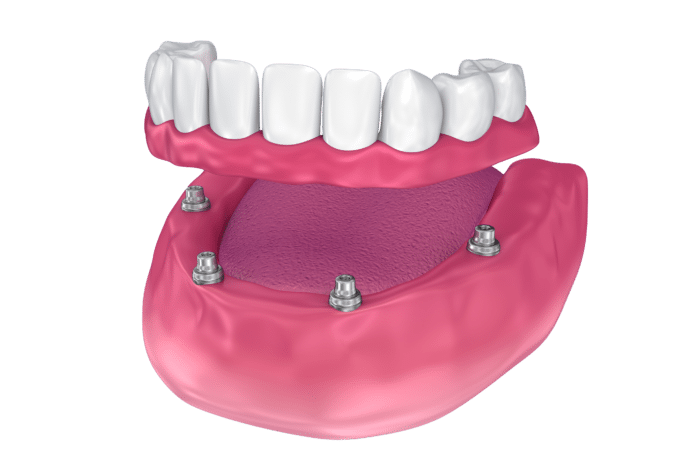 dental implant supported denture new philadelphia oh
