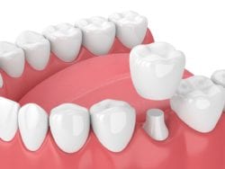 dental crowns in new philadelphia, ohio