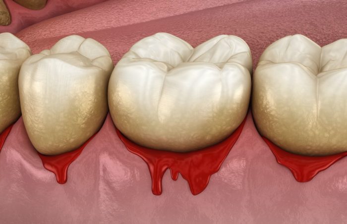 treat bleeding gums in New Philadelphia Ohio