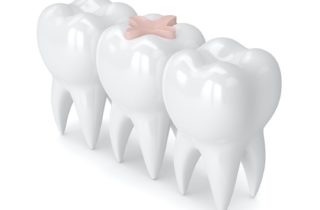 tooth colored dental fillings