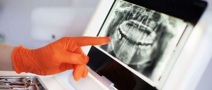 dental x-rays and preventative dentistry