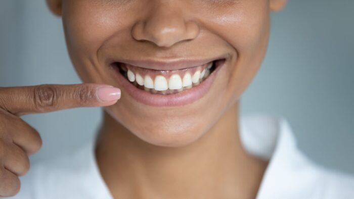 Fix Aesthetic Damage After Gum Disease