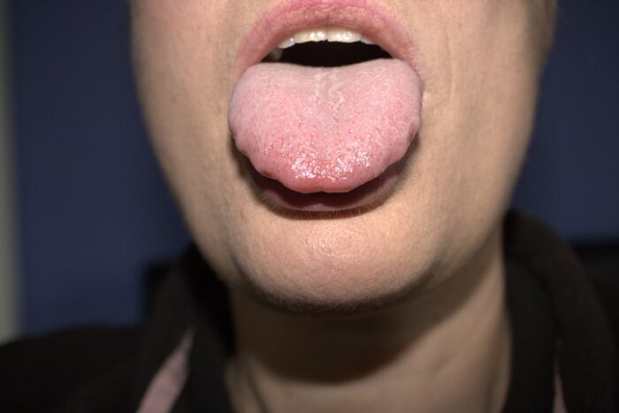 Why Does My Tongue Appear Scalloped