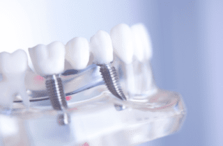 Understanding the differences between a traditional and implant-supported dental bridge is essential for your oral health.