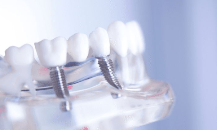 Understanding the differences between a traditional and implant-supported dental bridge is essential for your oral health.