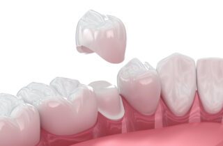 Though it might seem like an emergency, staying calm and taking the right steps can prevent further damage if a crown falls off.