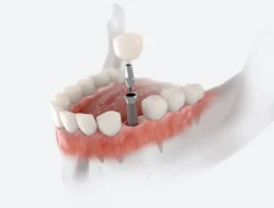 Dental Implants In-House in New Philadelphia, OH