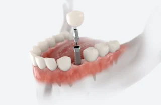 Dental Implants In-House in New Philadelphia, OH